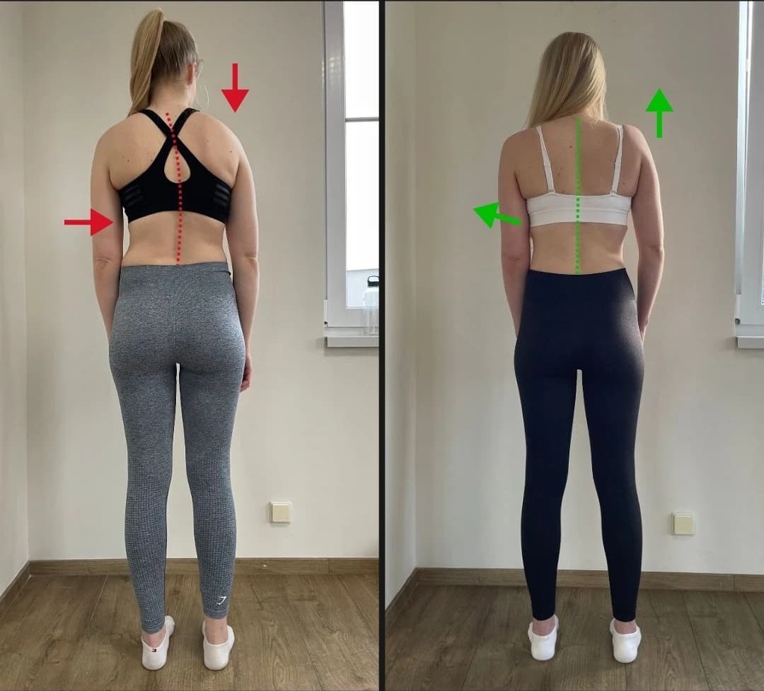 Before and after: back pain and scoliosis — spinal alignment restored
